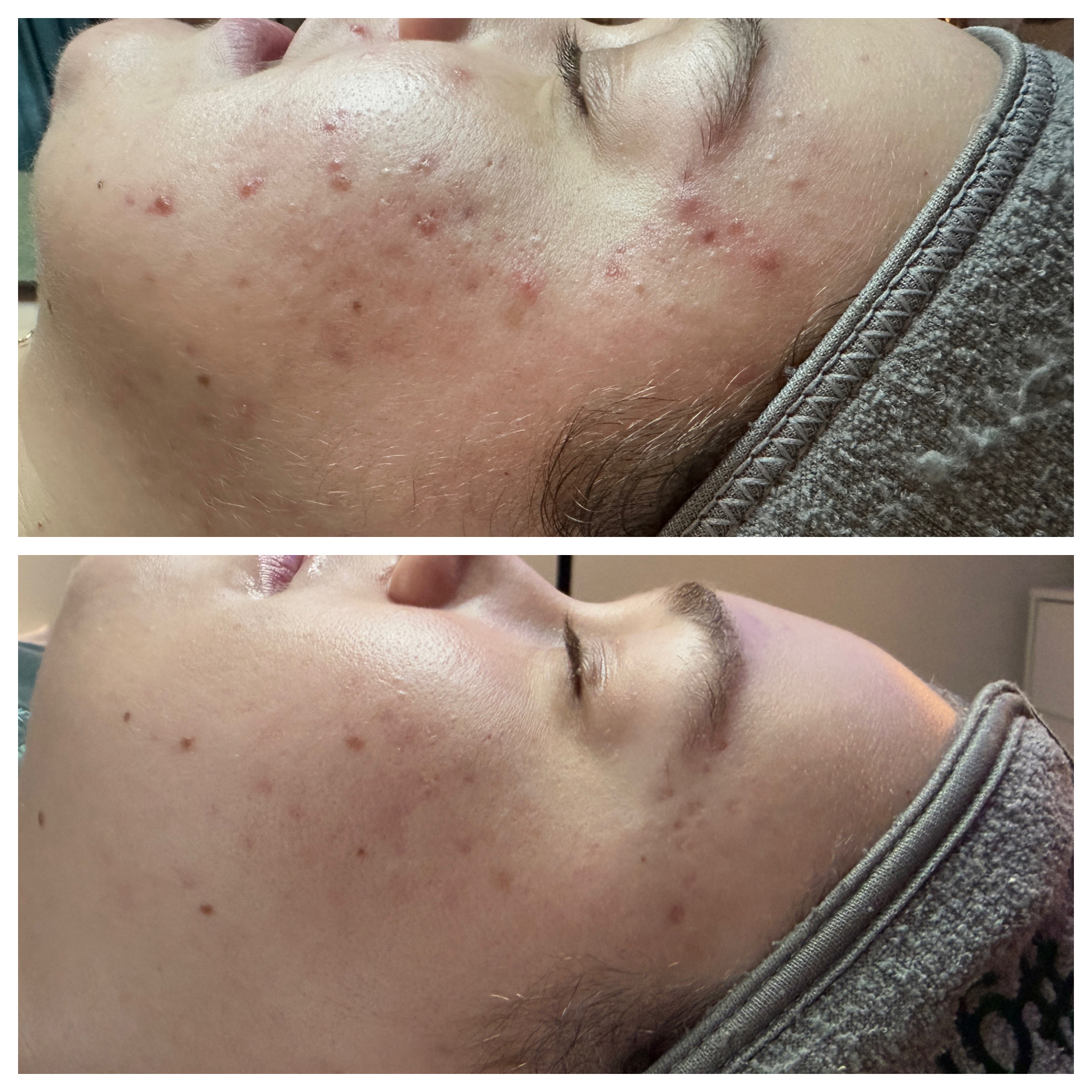 Side view of a person's face showing improvement in acne, with fewer pimples and clearer skin after treatment.