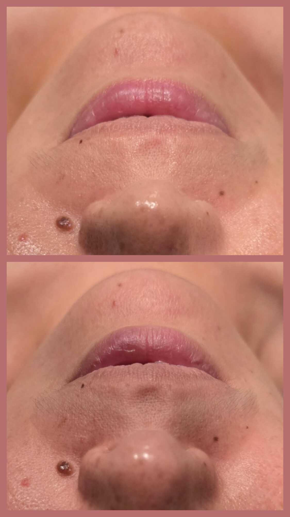 Two close-up views of a person's lips, nose, and chin, with a dark mole near the lower lip area.