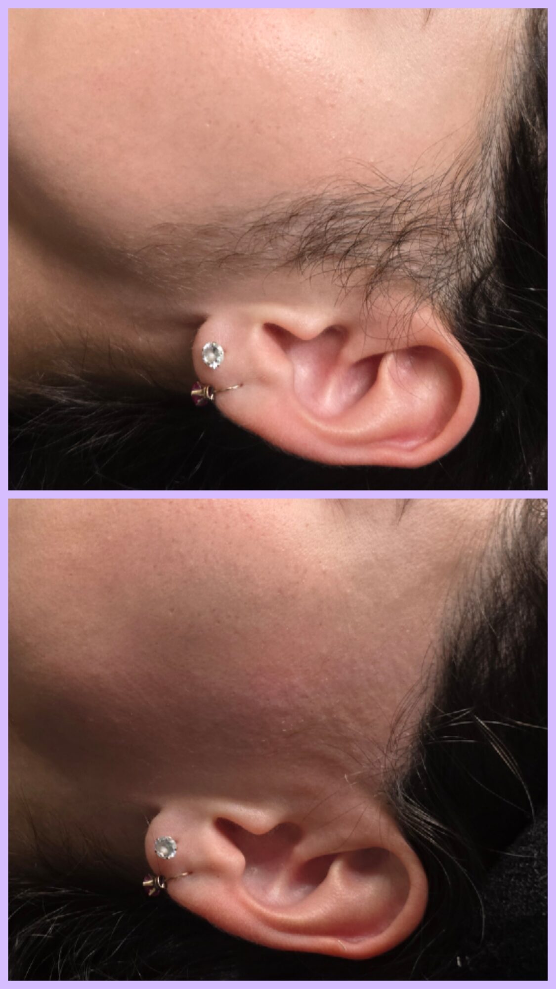 Two close-up photos show an ear with a small silver piercing before and after jewelry removal.